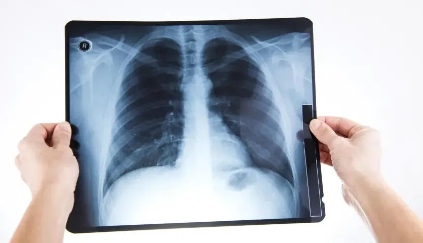 Złamane żebro: Objawy, pierwsza pomoc i leczenie poradnik