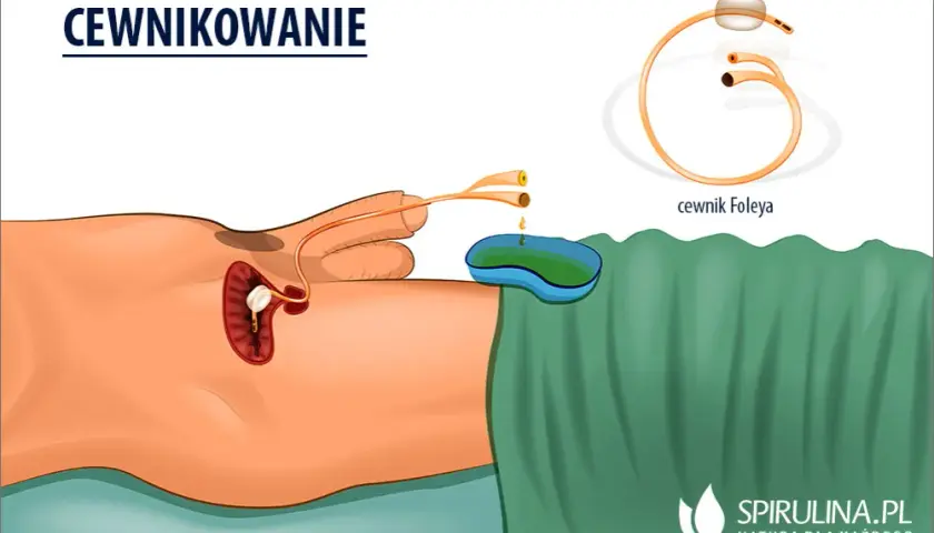 Po wyjęciu cewnika: objawy, zalecenia i kiedy iść do lekarza